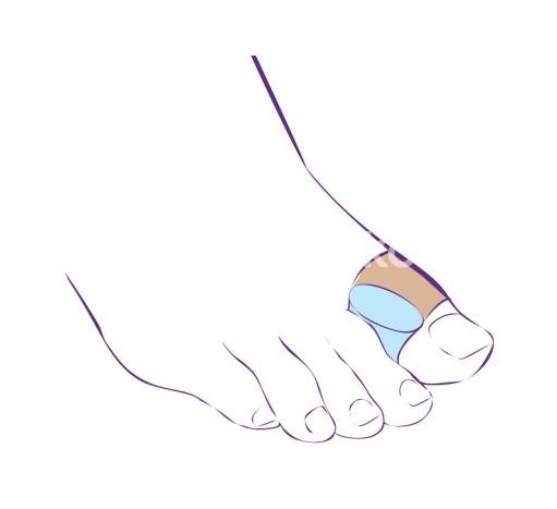 Тривес межпальцевая перегородка р.m /арт.ст-54.4/ Тривес межпальцевая перегородка р.m /арт.ст-54.4/ - 4